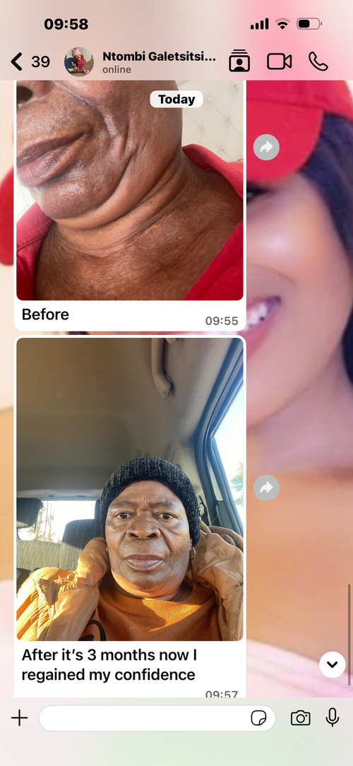 Bare combo  acne pigmentation blemishes  dark sports