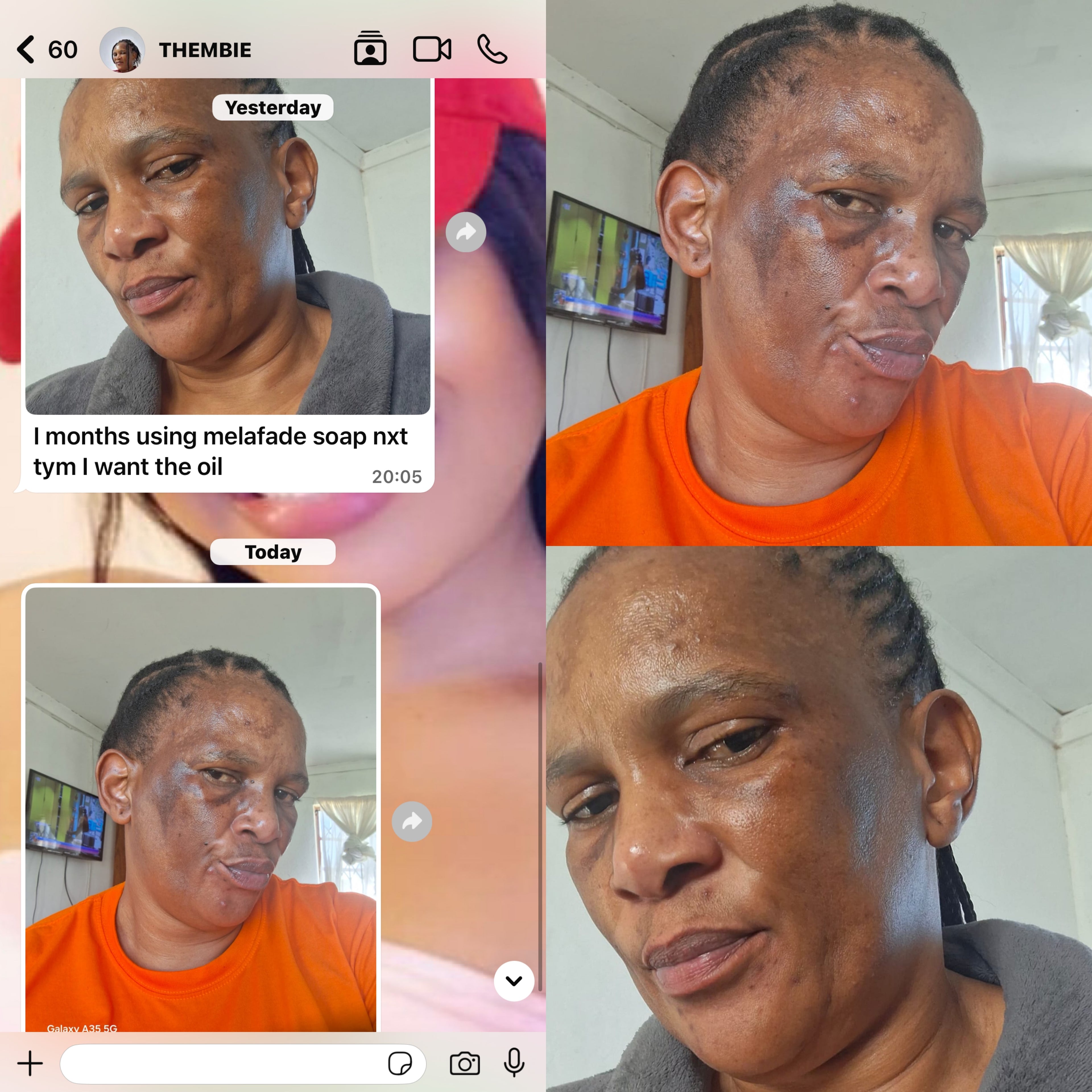Bare combo  acne pigmentation blemishes  dark sports